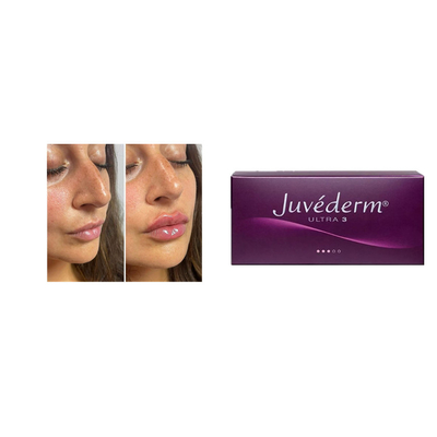 Juvederm 2*1ml 크로스 링크드 피부 필러 주름 방지 얼굴 필러