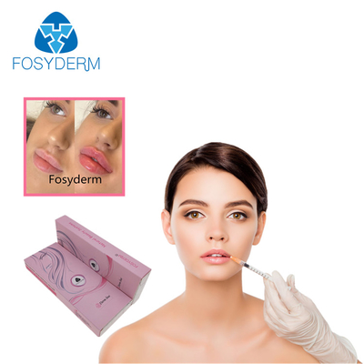 Fosyderm 2ml 입술 증진 주사 가능한 피부 충전물 Hyaluronic 산 젤 주입