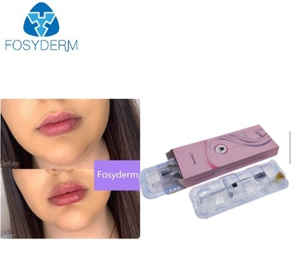 입술 증진, Hyaluronic 산 주사 가능한 충전물을 위한 2ml Hyaluronate 산성 젤