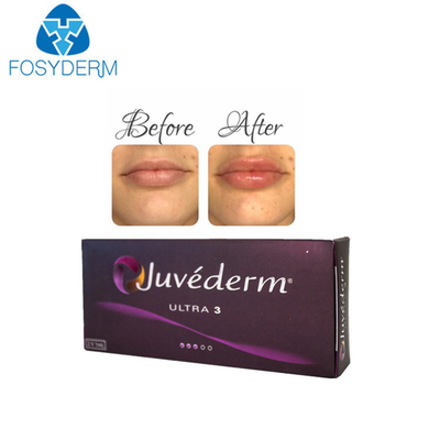 Juvederm Ultra 3 1 Ml * 2 히알루론산 피부 필러 립 인젝션