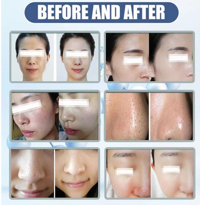 가장 좋은 얼굴 관리 홈 미세 피부 가려기 기계 2024 미용 장비 6