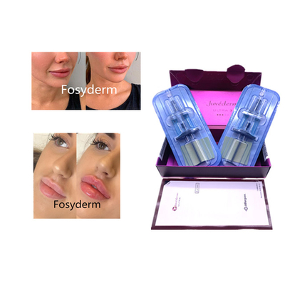 Juvederm 히알루론산 피부 필러 노화 방지 2*1ml 얼굴 필러