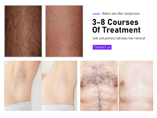 미용 장비 Fosyderm 레이저 제모 기계 3 파 12 바