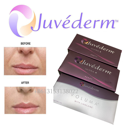 Juvederm Voluma 히알루론산 얼굴 립 필러