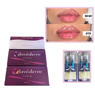 Juvederm Voluma Ultra3 Ultra4 HA 젤 필러 2 Ml 히알루론산