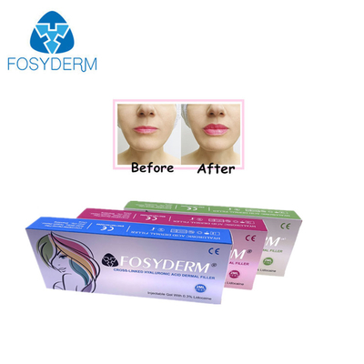 주름 감소 및 얼굴 모양을위한 젤 1ml 히알루론산 필러