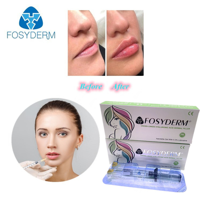 주름 감소 및 얼굴 모양을위한 젤 1ml 히알루론산 필러