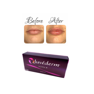 Juvederm 주사용 히알루론산 피부 필러 젤