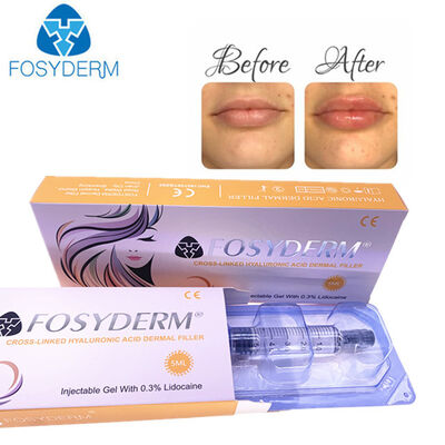 히알루론산 피부 필러 안티 주름 얼굴 리프팅 1ml 2ml