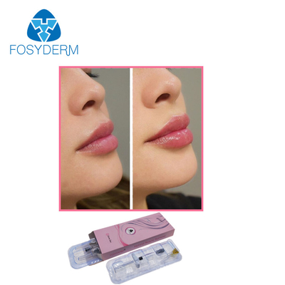 입술 증진을 위한 Fosyderm 감성론 1ml Hyaluronic 산 주입 피부 충전물