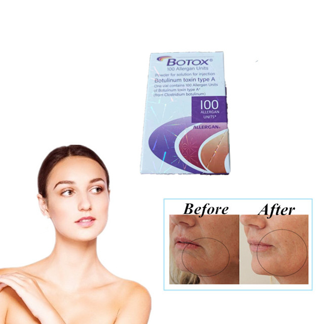Allergan  100 단위 유형 보툴리눔 독소 주사 주름 방지