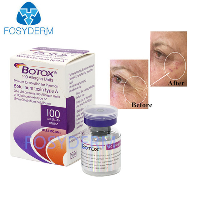 A Type A 100 단위 Allergan Botulinum Toxin Dermal Filler Hyaluronic acid