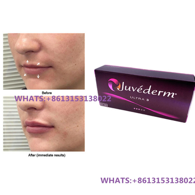 Juvederm 입술용 피부 필러 Juvederm Ultra3 Ultra4 필러 사전 충전 주사