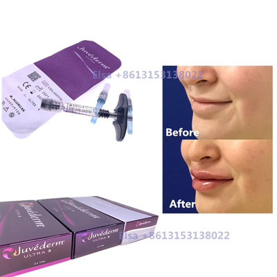 2×1ml 주사용 피부 필러 주브더마 주사기 Ultra3 Ultra4 볼륨