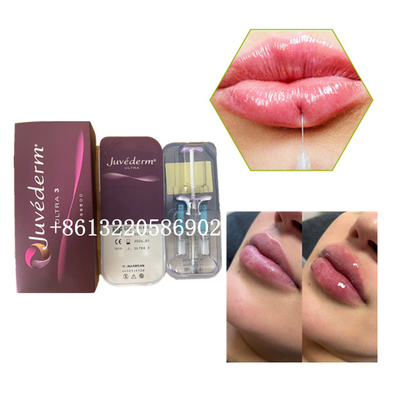피부에 관한 Ultra3 주이더텀 Lip 충전기 주입 2 밀리람베르트 히알루론산