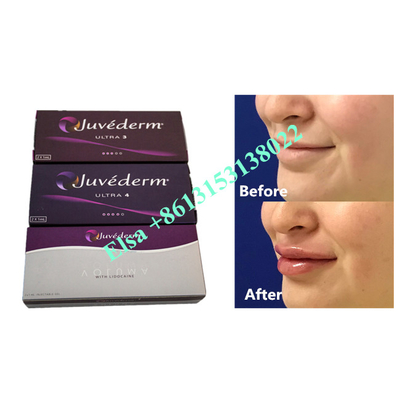 Voluma Hyaluronic 산 Fosyderm 피부 충전물 주입 24mg/Ml