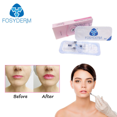십자가에 의하여 연결되는 주입 젤 Hyaluronic 산 피부 충전물 노화 방지 세륨 ISO