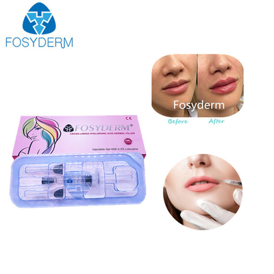 2 Ml Acid Hyaluronic Cross Linked Dermal Filler 립 필러 주사