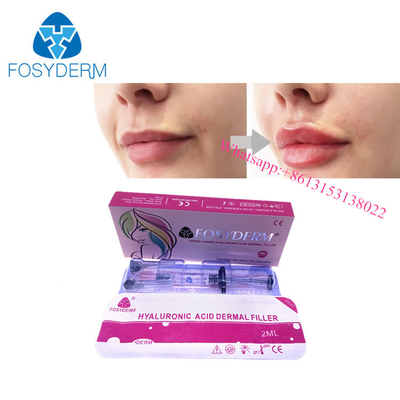 OEM Lip 확대 히알루론산 피부 필러 겔 주입