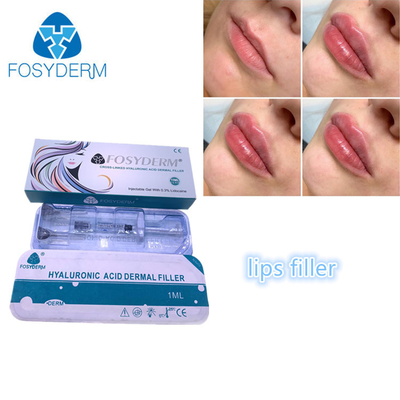 얼굴 주입 포스이더텀 포스이더텀 히알루론산 Lip 충전기 1 밀리람베르트를 충전하기